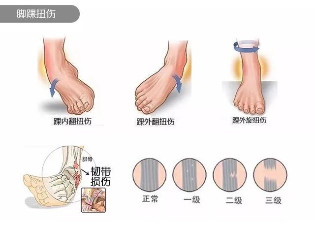 nba脚踝扭伤治疗 从东契奇的崴脚(2)