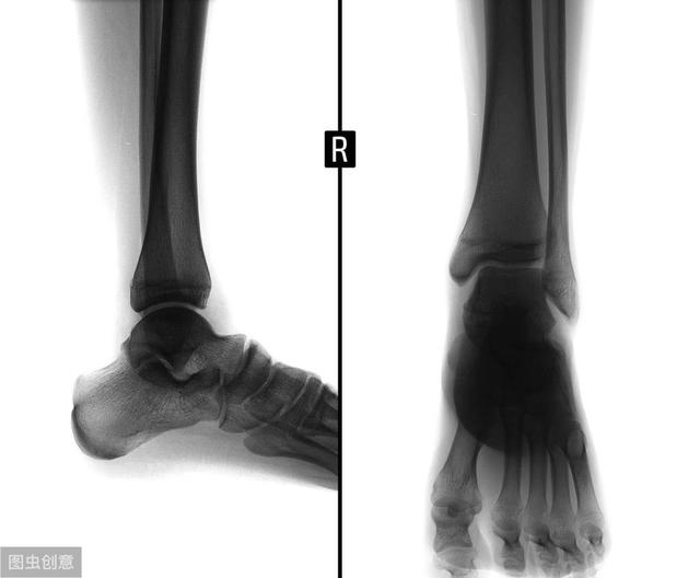 nba脚踝扭伤治疗 从东契奇的崴脚(3)