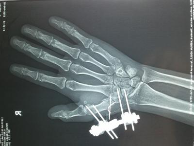 nba保罗骨折 加索尔手掌骨折手术(3)