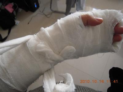 nba保罗骨折 加索尔手掌骨折手术(4)
