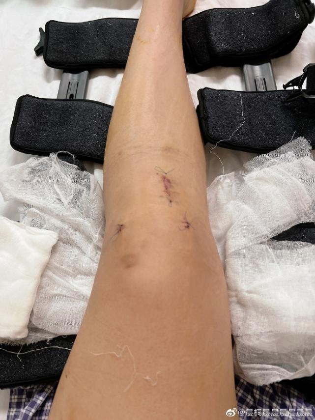 ​中国女篮世界杯亚军成员武桐桐晒照：腿部有明显手术疤痕(3)